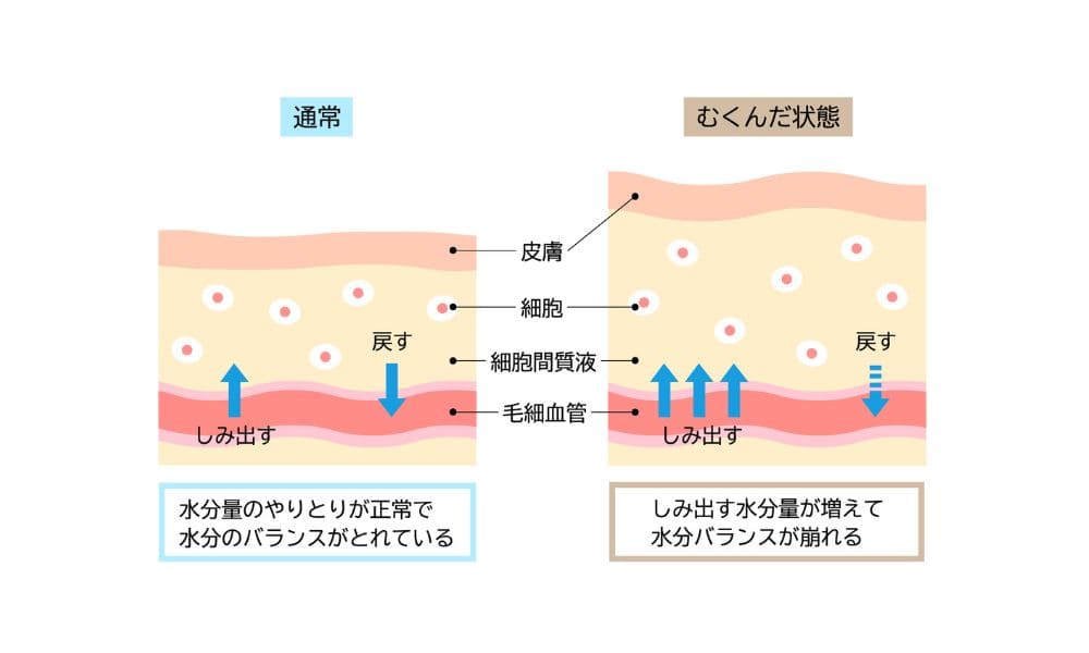 むくみの仕組みイラスト